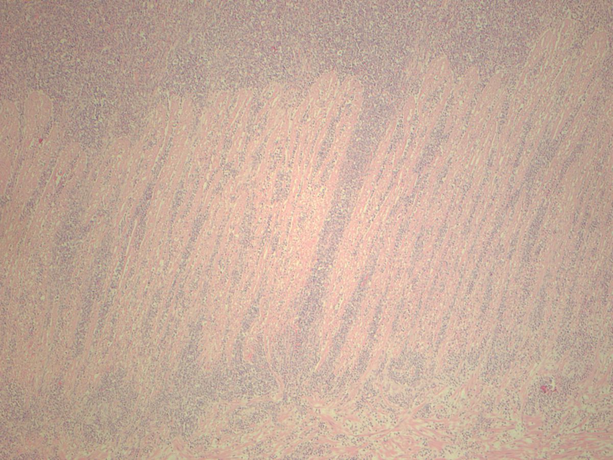 Small bowel myeloid sarcoma (H&E 40X)